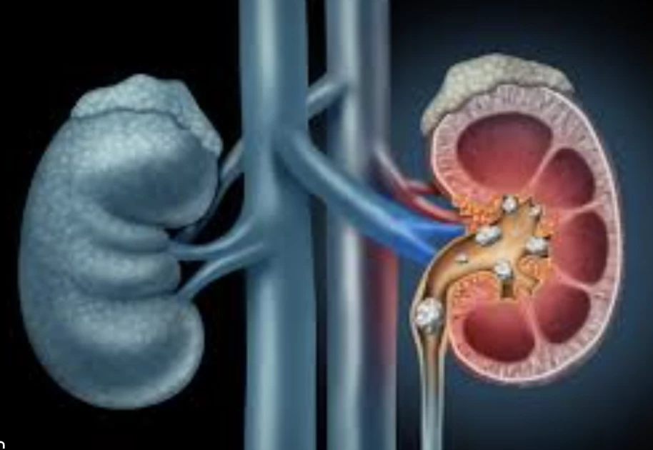 Understanding Kidney Stones: Causes, symptoms, and treatment options Understanding Kidney Stones: Causes, symptoms, and treatment options
