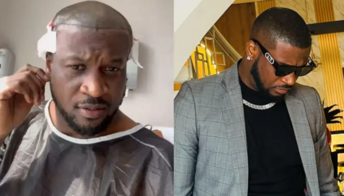 How Turkey became the hair transplant capital of the world