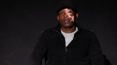 Unveiling the beauty of diversity: Celebrating World Vitiligo Day