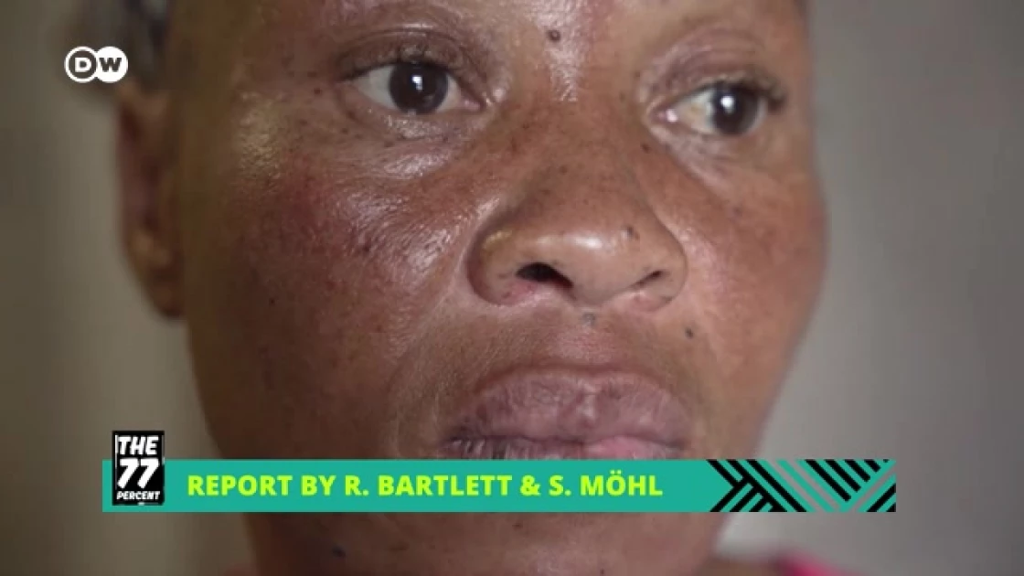 Skin Bleaching Risks Skin Bleaching: The Risks Behind the Beauty Craze