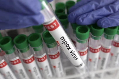 Three Mpox cases confirmed in Nyandarua County