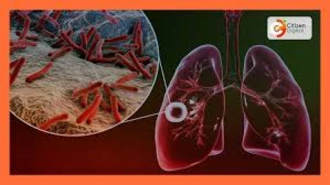 Funding crisis threatens Kenya’s progress in TB fight