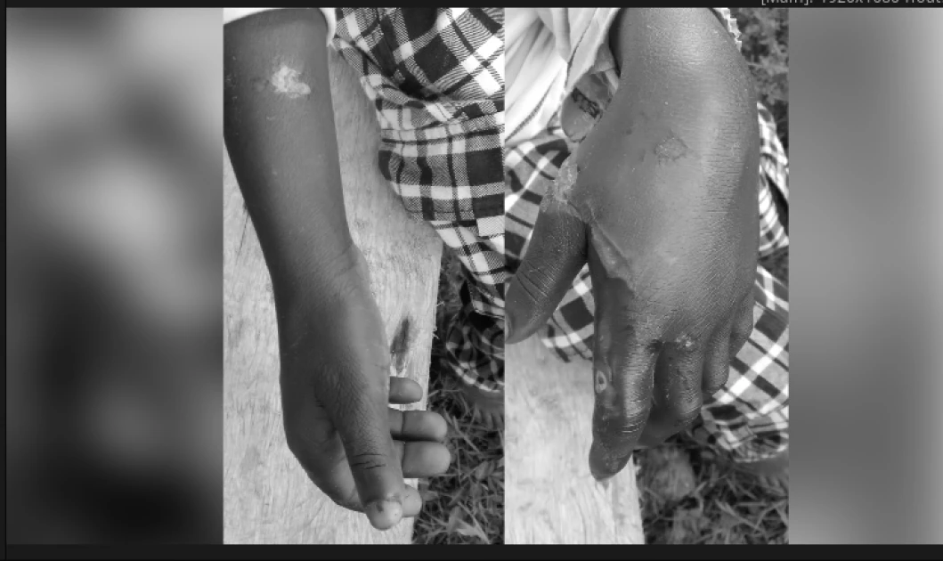 Couple arrested in Ndhiwa for allegedly burning son’s hands over stolen fish