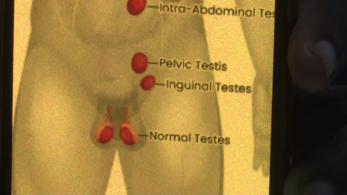 Doctors troubled by cases of undescended testis in Nyandarua, Laikipia children 