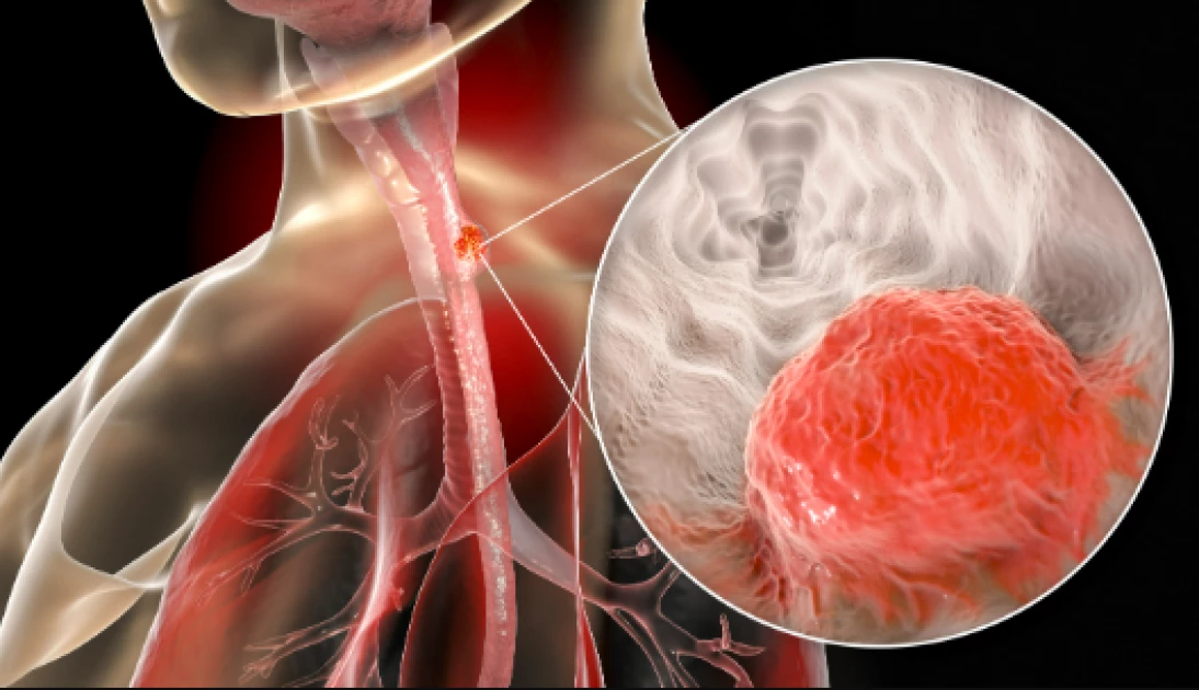 Expert warns of rising Oesophageal Cancer threat in Kenya