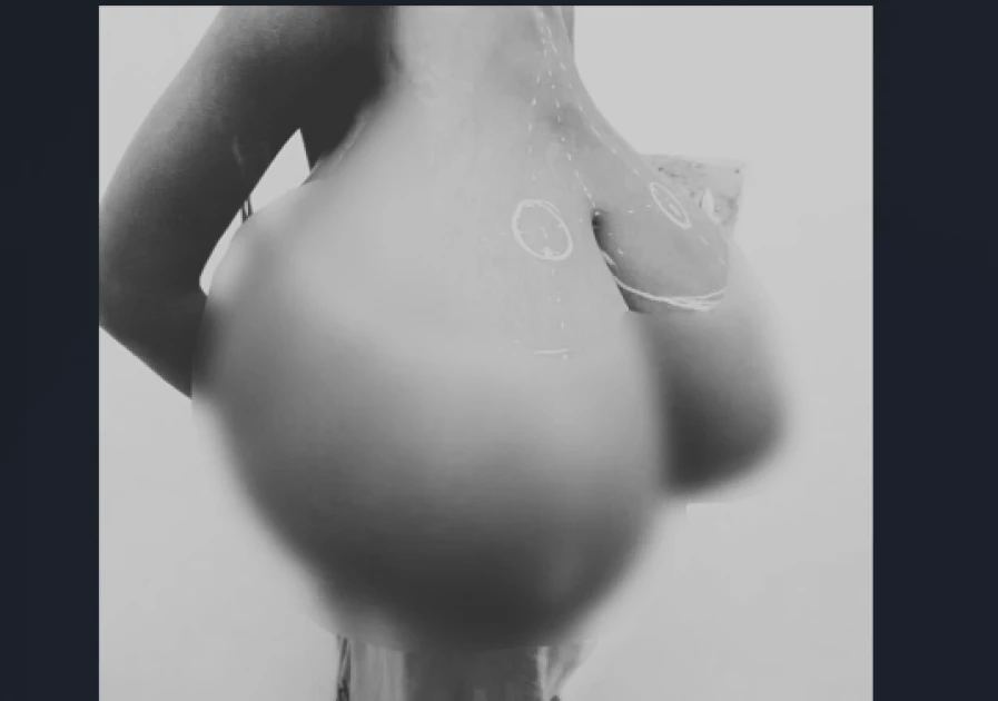 KNH successfully removes 20KG of breast tissue from teen with Gigantomastia KNH successfully removes 20KG of breast tissue from teen with Gigantomastia