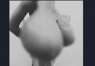KNH successfully removes 20KG of breast tissue from teen with Gigantomastia