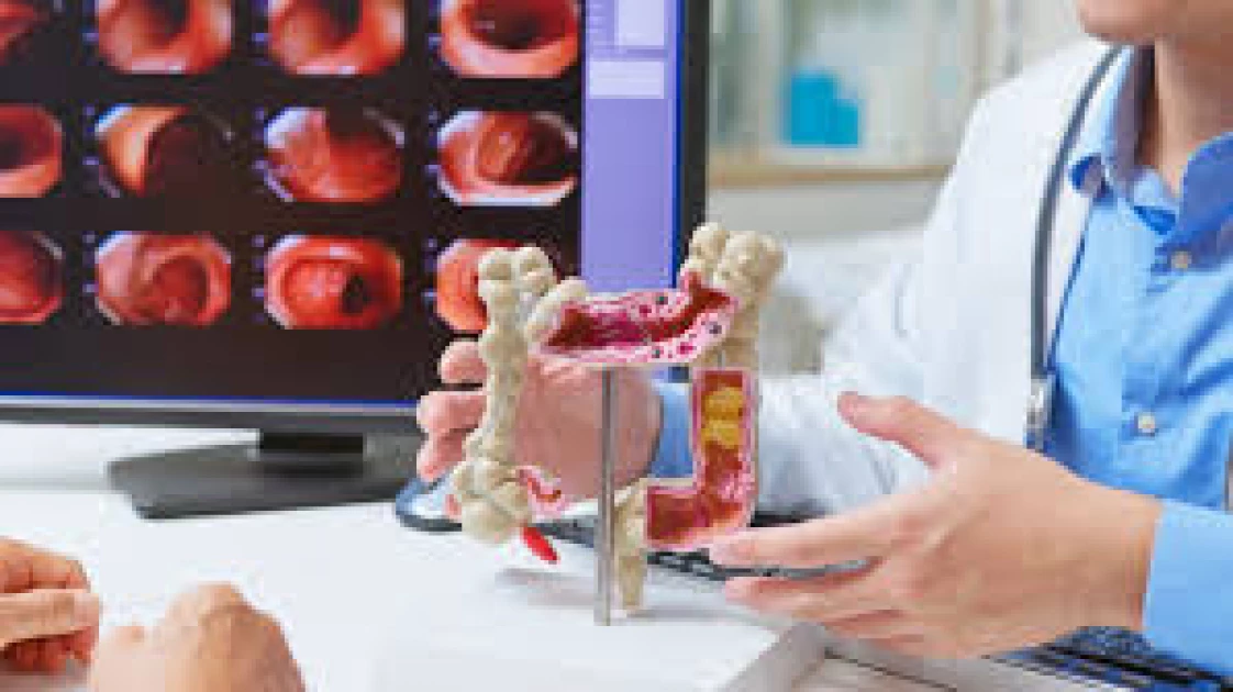 Why are more under-50s getting colorectal cancer? 'We don't know'